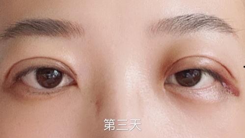 做埋线双眼皮视频,跟随埋线双眼皮视频教程，打造迷人电眼