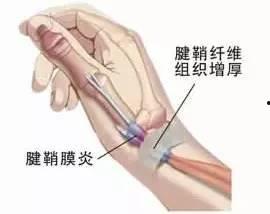 尚赫调理静脉曲张视频,揭秘静脉曲张的调理之道